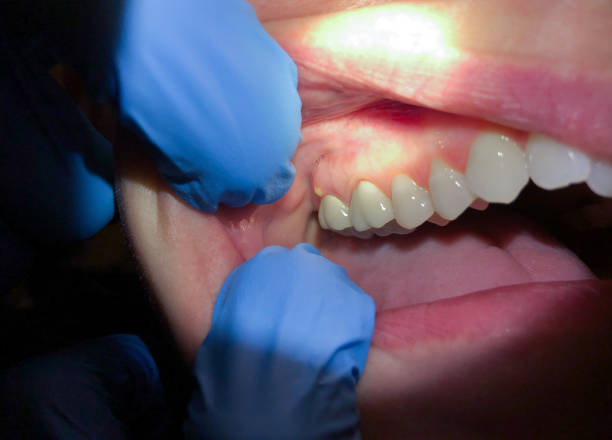 Best Emergency Tooth Extraction in Carlisle, KY